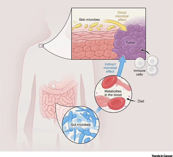 A microbiota humana e sua relação com o desenvolvimento de tumores
